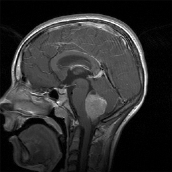 Southern Beamy Brain Damage